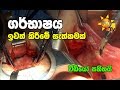 uterine-removal-surgery-live-24-08-2019
