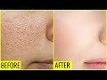 How to Get Rid of Large OPEN PORES Permanently 01-08-2019